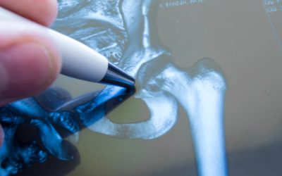 CPT Codes for Total Hip Arthroplasty: Key Considerations for Orthopedic Surgeons